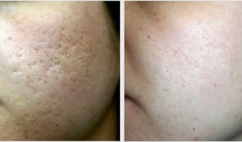 HB Laser and skin therapy